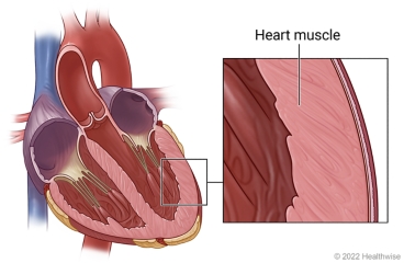 Cross section of heart, with close-up of heart muscle that makes up the wall of the heart.