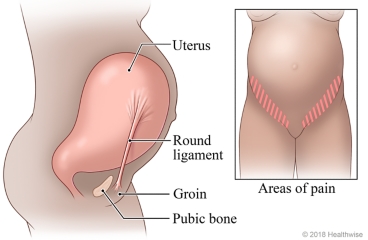 Lower abdomen (round ligament) pain in pregnancy