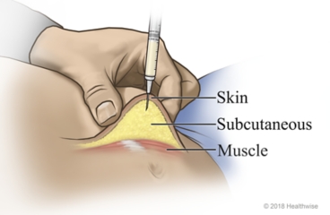 Needle through skin in subcutaneous tissue, not into muscle
