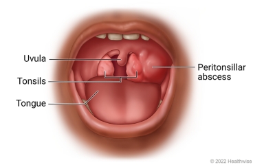 Child's open mouth and throat, showing tongue, tonsils, uvula, and peritonsillar abscess near a tonsil.