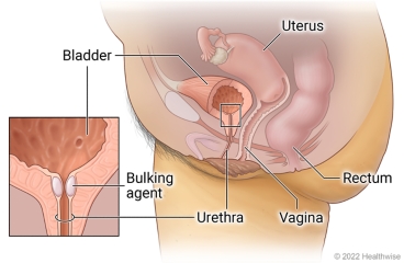 Side internal view of female pelvic organs, including uterus, bladder, urethra, vagina, and rectum, with detail showing bulking agent around urethra near bladder.