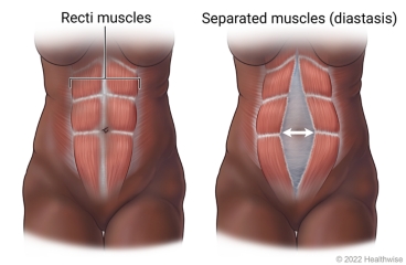 Recti muscles down the front of the belly, showing unseparated recti muscles and separated recti muscles.
