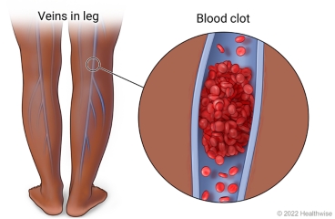 Learn About Deep Vein Thrombosis/Blood Clots