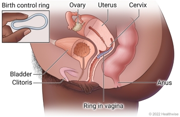 Side view of female pelvic anatomy in lower belly, showing clitoris, bladder, ovary, uterus, cervix, anus, and position of ring in vagina, with detail of birth control ring.