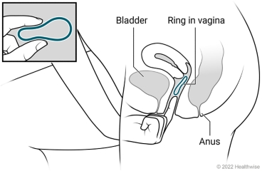 Birth control ring, showing ring being placed in vagina.