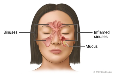 Sinuses in face around eyes and nose, showing clear sinuses on one side of face and inflamed sinuses with mucus buildup in a sinus on the other side.