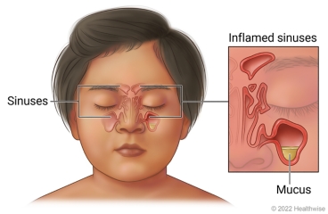 Sinuses in child's face around eyes and nose, showing clear sinuses on one side of face and inflamed sinuses with mucus buildup in a sinus on other side.