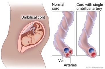 The location of the umbilical cord during pregnancy, with detail of a normal cord versus a cord with a single artery