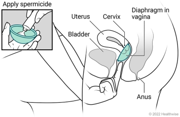 Female pelvic organs, showing uterus, cervix, bladder, and anus, with spermicide put in diaphragm and placed in vagina at cervix.