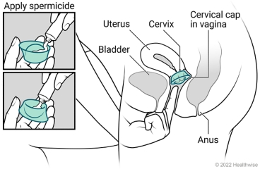Female pelvic organs, showing uterus, cervix, bladder, and anus, with spermicide put on both sides of cervical cap and placed in vagina at cervix.