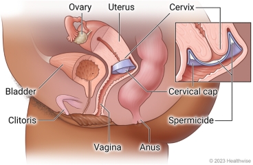 Female pelvic organs, showing an ovary, uterus, cervix, bladder, clitoris, and anus, with spermicide put in cervical cap and placed in vagina at cervix.