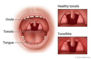 Child's open mouth showing uvula, tongue, and tonsils, with detail of healthy tonsils and tonsils red and swollen with tonsillitis.