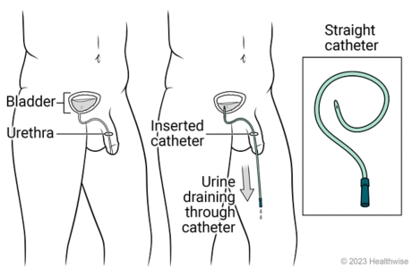 Bladder and urethra, showing catheter inserted in urethra and urine draining through catheter, with detail of straight catheter.