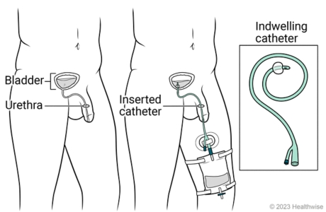 Catheter inserted into penis, through urethra and into bladder and held in place with inflated balloon, showing urine draining into collection bag strapped to leg.