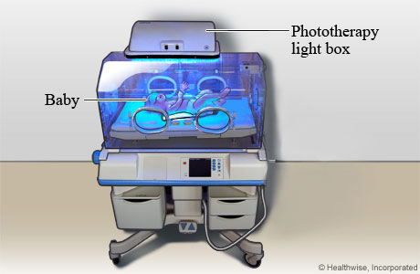 Baby getting phototherapy for jaundice.