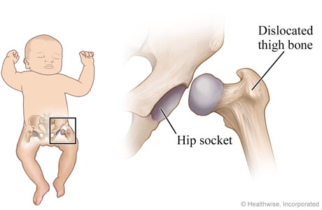 Hip dysplasia in a child.