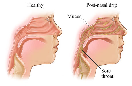 Inside view of head, showing the sinuses with post-nasal drip draining into the throat.