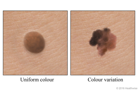 A mole of uniform colour and a mole showing colour variation