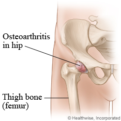 Picture of osteoarthritis of the hip