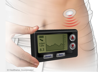 Insulin Pumps & Continuous Glucose Monitors