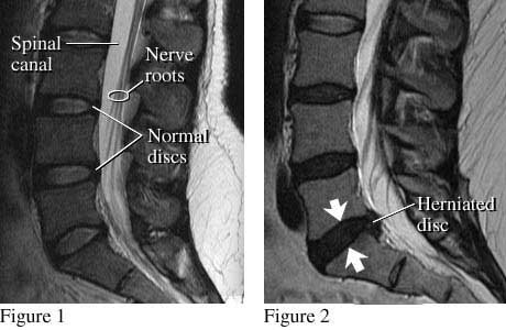 Images of normal discs and a herniated disc.