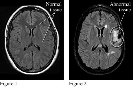 Images of normal brain tissue and abnormal brain tissue that causes seizures.