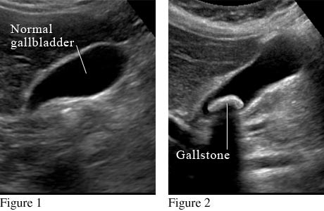 Abdominal ultrasound of gallbladder.