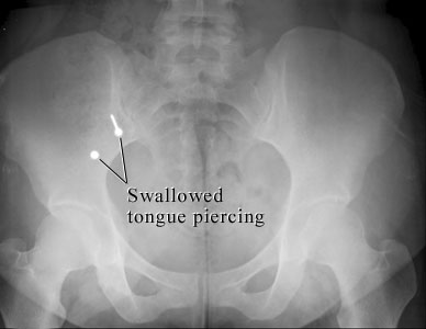 Image of swallowed tongue piercing.