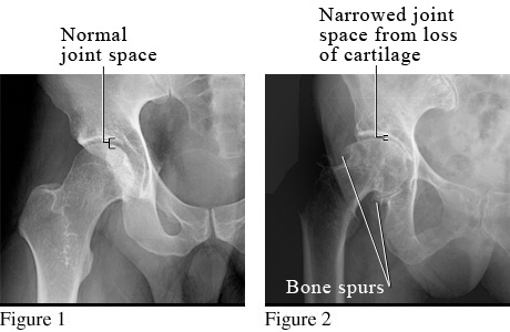 X-ray of osteoarthritis of the hip.