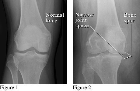 X-ray of osteoarthritis of the knee.