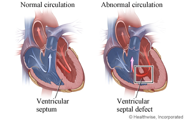 Normal heart and heart with ventricular septal defect