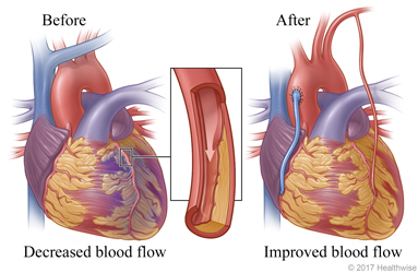 Decreased blood flow caused by narrowed or blocked artery before surgery and improved blood flow after surgery.