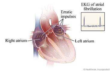 Erratic impulses in heart during atrial fibrillation and resulting EKG