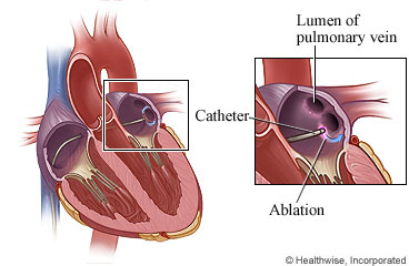 Catheter ablation inside the heart