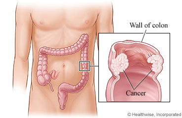 Cancer in the colon