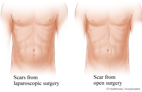Comparison of laparoscopic surgery scars and open surgery scar