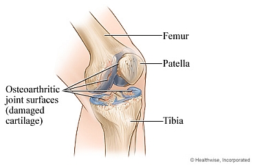 Knee joint with damaged cartilage