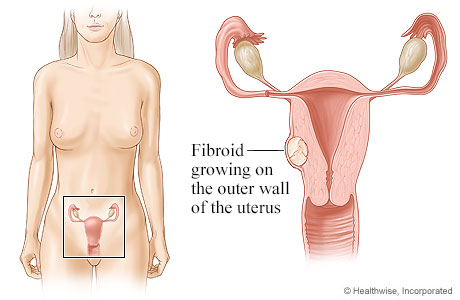 Location of uterus and ovaries, with detail of fibroid growing on outer wall of uterus.