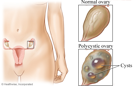 Location of the ovaries with closeup of a normal ovary and a polycystic ovary.