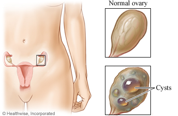 Normal ovary and ovarian cyst