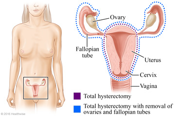 Total hysterectomy and total hysterectomy with removal of ovaries and fallopian tubes.