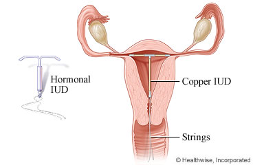 Two types of intrauterine devices or IUDs