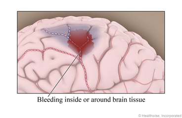 Bleeding inside or around brain tissue