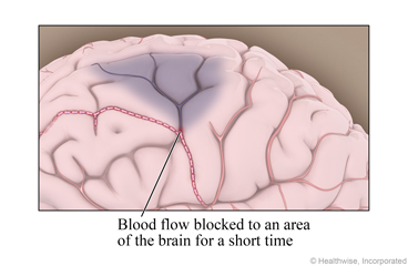 Blood flow blocked to an area of the brain for a short time