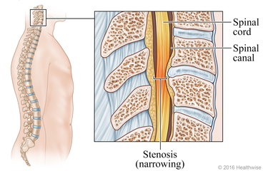 Skeletal view of spine, with detail of narrowed spinal canal in cervical area (neck)