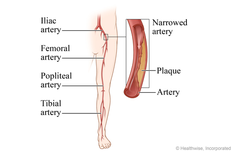Peripheral arteries of the leg, with detail of the iliac artery narrowed by plaque