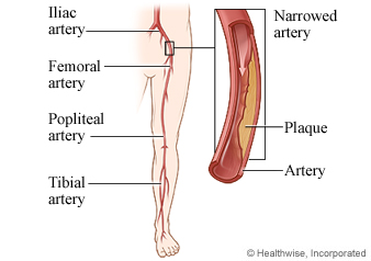 Artery in leg narrowed with plaque