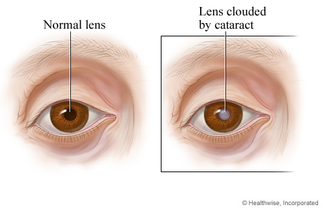 A normal lens compared to a lens clouded by a cataract.