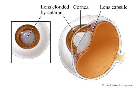 An eye lens clouded by a cataract (close-up).