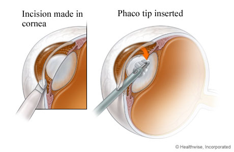 Incisions and opening created to begin cataract surgery.